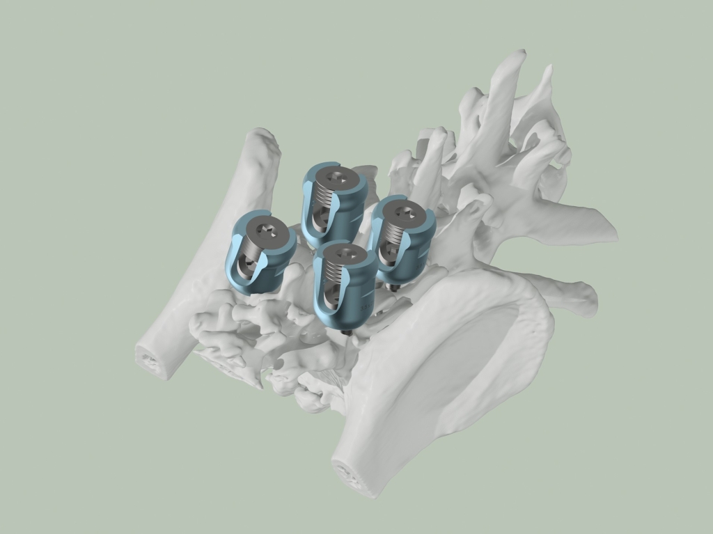 3D imaging showing the planned screw positions for spinal surgery on Teebo the Finnish Lapphund at North Downs Specialist Referrals. 